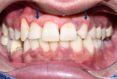 1.송곳니를 다른 앞니 모양 라미네이트로, 2.치아사이 빈공간을 라미네이트로 관련 이미지 2