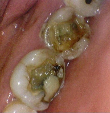 서대문역 지르코니아 크라운, 연세예감치과에서 알려드려요[실제환자사례] 관련 이미지 2