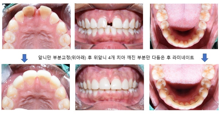 명동 가까운 치과 /외국인 흑인분의 매우 벌어진 앞니 치료 (빠른 부분교정(3개월)+라미네이트)/가격안내 관련 이미지 4