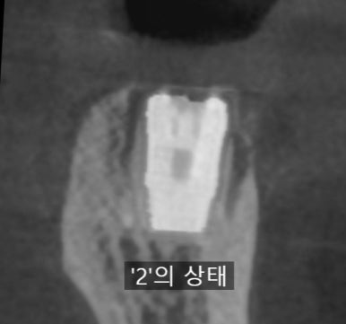 오래된 임플란트가 흔들려요 인플란트 재수술도 서울역가까운치과 연세예감치과 관련 이미지 16