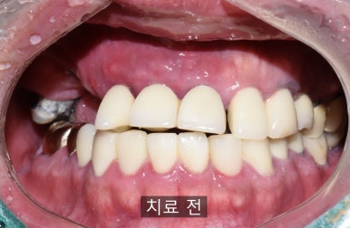 앞니 여러개 임플란트 잘하는 치과 서울역치과 실제사진 관련 이미지 9