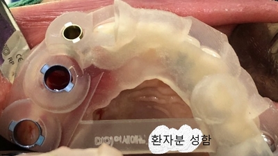 시청역,광화문 직장인에게 필요한 빠른 임플란트! 수술이 무서운 어르신들에게 만족도 높은 임플란트! 관련 이미지 3