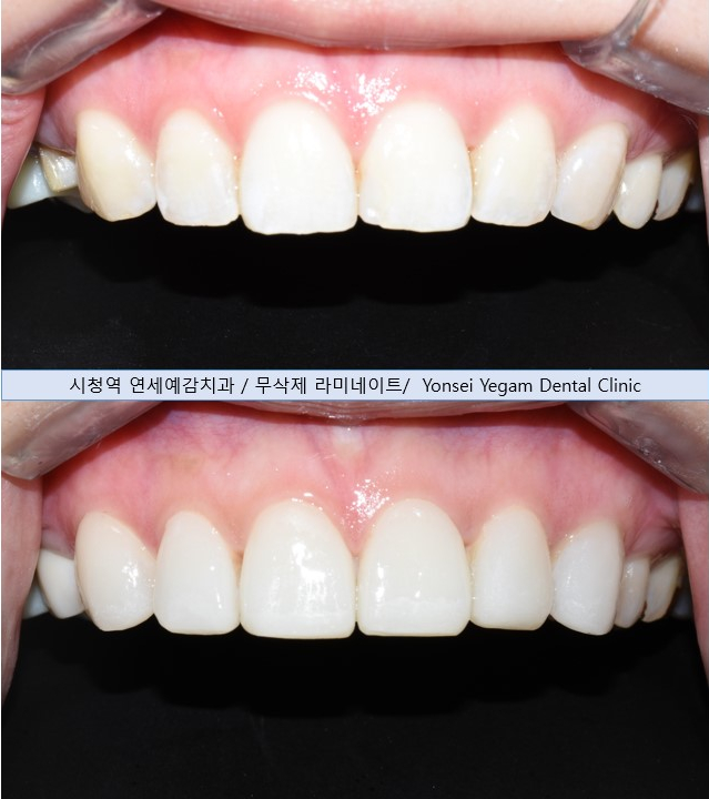 [서울시청역치과] 옥니 간단한 해결방법 찾고 계신가요? &rarr;이벤트안내 관련 이미지 7