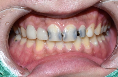 시청역치과 치아가 부러졌어요 치아가 너무 많이 썩어서 앞니가 거의 없는 치아의 크라운 케이스 관련 이미지 3