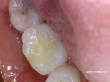 충정로 치과 인레이 해야한다고 들었는데 충치가 안보여요 관련 이미지 12