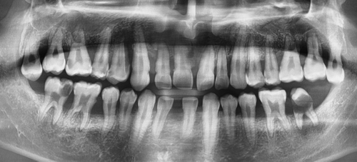 시청역치과 벌어진 앞니를 바르고 이쁘게! 대한심미학회회원치과 관련 이미지 2