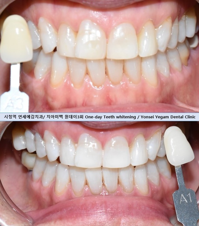 결혼 전 예비신부 예비신랑 필수코스가 된 치아미백에 대해 알아보아요, 전후, 가격포함 관련 이미지 3