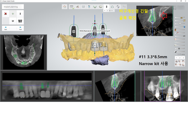 [서울시청역/서울역] 앞니 임플란트 가능할까요? 앞니 내비게이션임플란트 관련 이미지 6