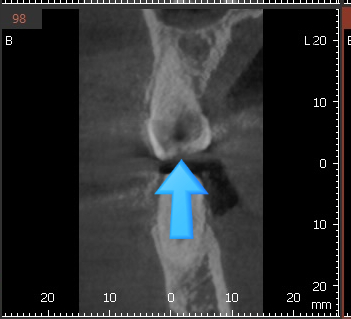광화문 시청치과 치아가 쪼개졌어요 실제사례 관련 이미지 3