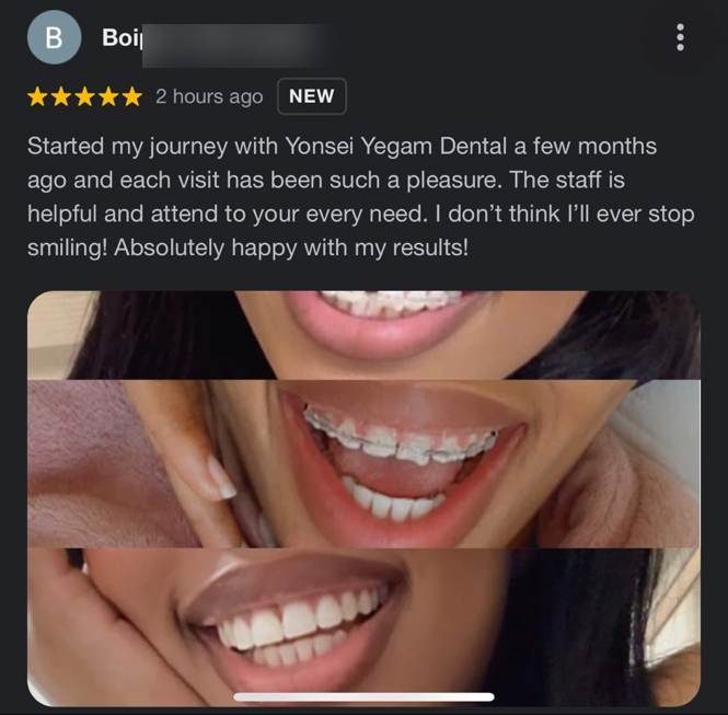 서울시청역치과/ 벌어진 앞니 치아 치료/ 왜소치, 다이아스테마 등/레진, 라미네이트, 부분교정 비교 관련 이미지 27