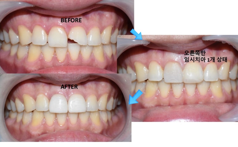 앞니깨짐 실제 치료 사례, 넘어져서 변색된 앞니 깨진 앞니 관련 이미지 9