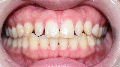 서울시청역치과/ 벌어진 앞니 치아 치료/ 왜소치, 다이아스테마 등/레진, 라미네이트, 부분교정 비교 관련 이미지 20