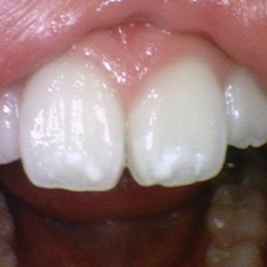 해외에서도 찾아오는 앞니레진치료, 광화문 시청역 서울역 근처 연세예감치과 외국인도 찾는 이유 관련 이미지 1