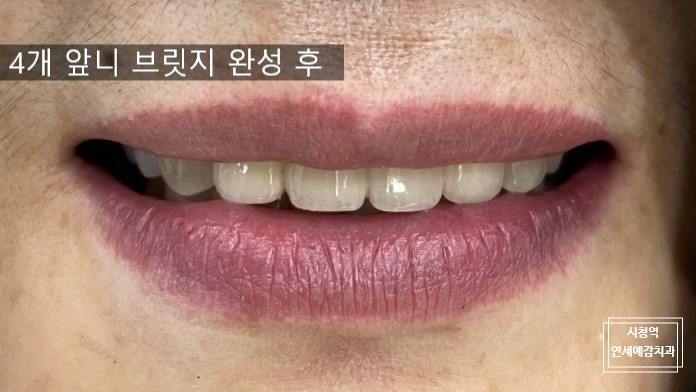 [치과브릿지]남대문치과/깨지고 오래된 앞니브릿지 교체케이스 관련 이미지 6