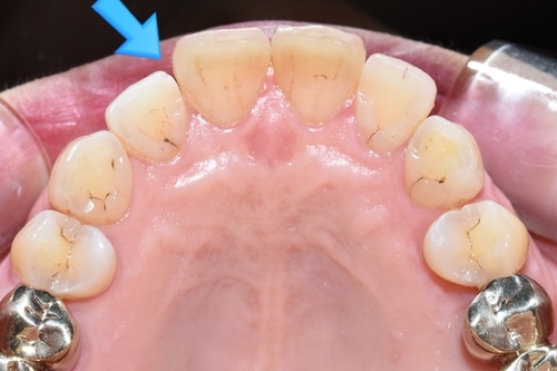 벌어진 앞니 교정치료 & 오래된 앞니 브릿지 다시하기 관련 이미지 3