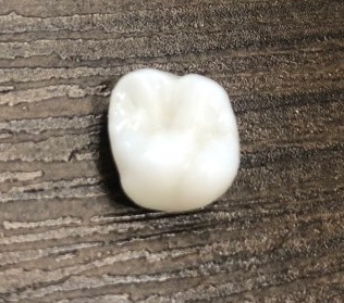 해외에서도 찾아오는 [시청역 연세예감치과]에서 알려드리는 지르코니아크라운 관련 이미지 4