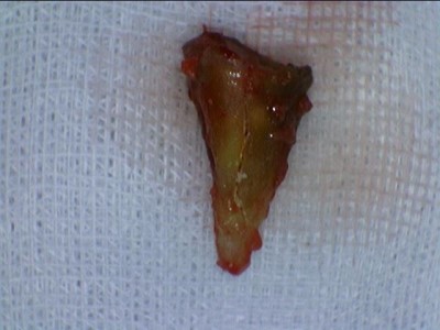 시청역치과/ 연세예감치과에서 "지르코니아 크라운" 알려드려요 관련 이미지 2