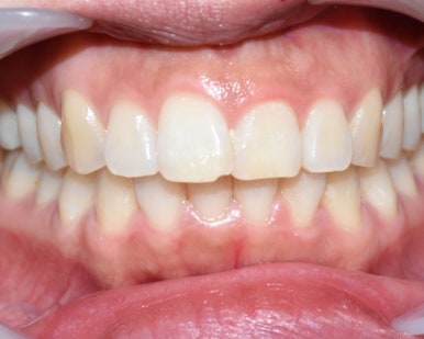 라미네이트 2개이상시 개당 50만원(부가세별도) 깨진 앞니 최소삭제한 라미네이트 케이스 관련 이미지 1