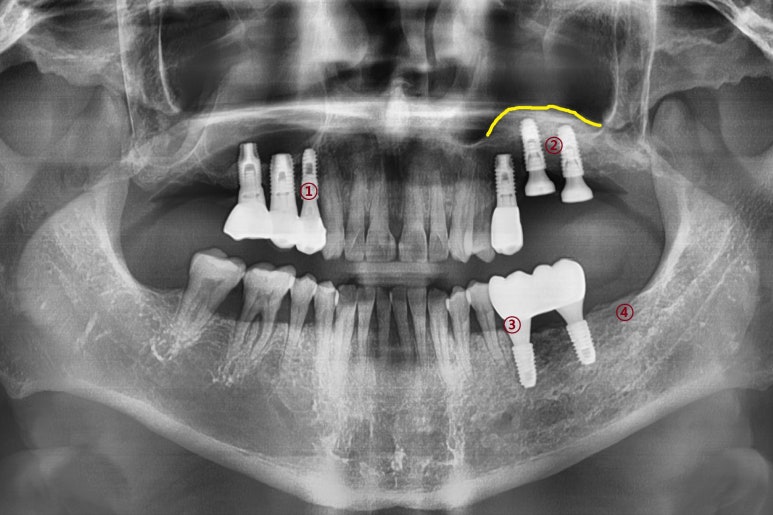 오래된 임플란트가 흔들려요 인플란트 재수술도 서울역가까운치과 연세예감치과 관련 이미지 2