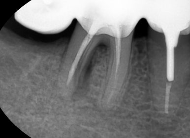 [서울역/치과] 고기 뼈를 씹고 치아가 부러졌어요 관련 이미지 9