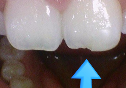 [서울역/시청역] 레진치료 : 화이트스팟(반상치) 케이스 & 치아패임으로 시린 케이스 & 깨진 치아 케이스 관련 이미지 7