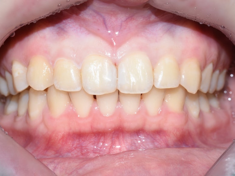 앞니충치가 너무 심해요 앞니 충치치료 방법 [시청역서울역 치과] 관련 이미지 9