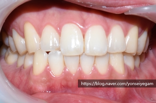 커피많이드세요? 치과에서 하는 치아미백 알려드려요[효과, 유지 등등 실제사례] 관련 이미지 7