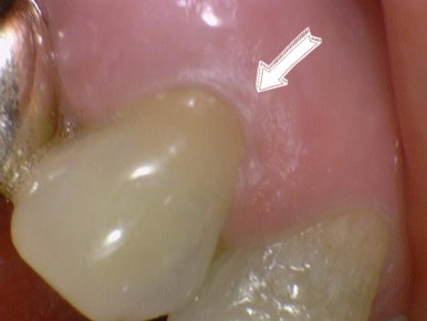 남대문치과 치아가 시리다면? 잇몸패임인가요? 관련 이미지 6