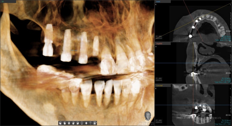 [시청역/서울역]네비게이션인플란트를 이용한 여러개 임플란트 과정 관련 이미지 10