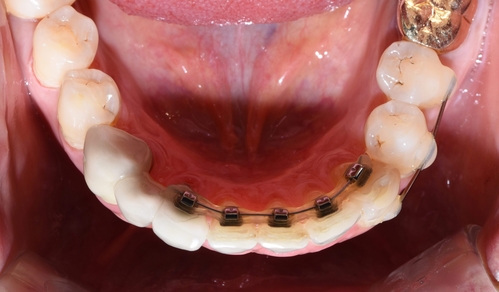 벌어진 앞니 교정치료 & 오래된 앞니 브릿지 다시하기 관련 이미지 5