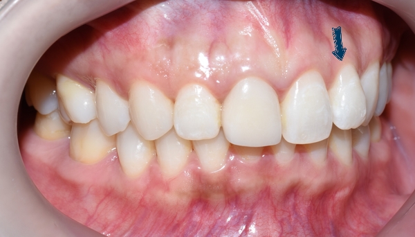 Q&A:"교정을 예전에 오래전에 했는데 앞니치아가 삐뚤어졌어요"해결방법은, 비용은? 관련 이미지 2