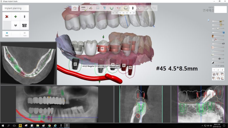[남대문시장] 임플란트 조금 더 안아프고 간편하게 관련 이미지 13