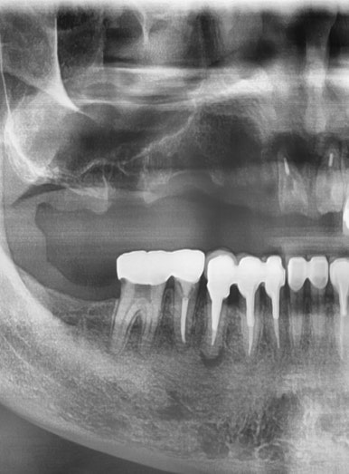 오래된 임플란트가 흔들려요 인플란트 재수술도 서울역가까운치과 연세예감치과 관련 이미지 5