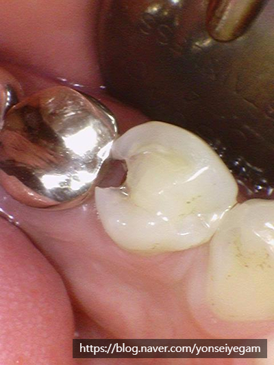 Q&A)충치, 꼭 치료해야 하나요?? 관련 이미지 3