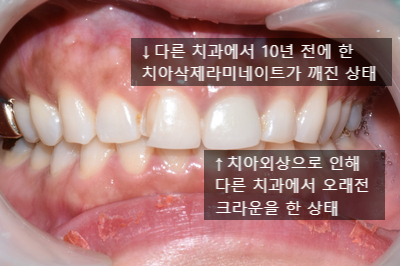 [시청역/광화문]라미네이트케이스:"치아가 작아서 옹졸해 보여요. 치아가 길어보이면 좋겠어요" 관련 이미지 2