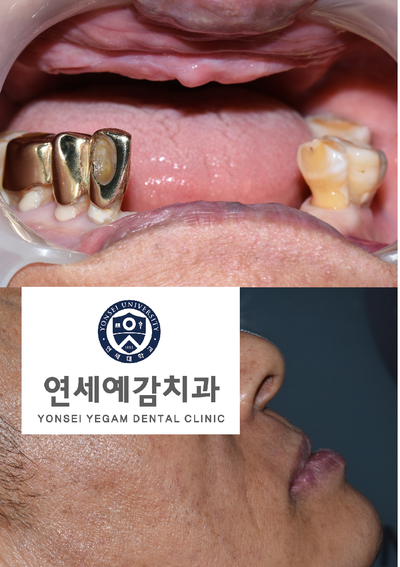 [종로/시청역]실제 환자의 보험 임플란트, 보험 틀니 사례 소개합니다. 젊어지는틀니,임플란트 치료 관련 이미지 10