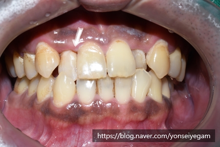 앞니가 너무 많이 썩었어요 앞니 충치치료 관련 이미지 7