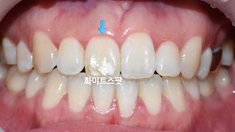 [서울 광화문/남대문] 화이트스팟 레진으로 치료케이스, 비용안내 등등 / 반점치, 반상치 관련 이미지 1