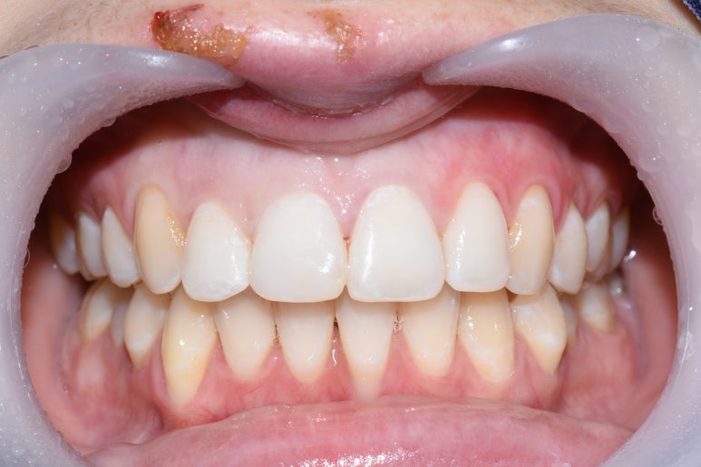 [시청역/서울역 치과] 앞니 치아부러짐 자연스럽게 치료사례 관련 이미지 7