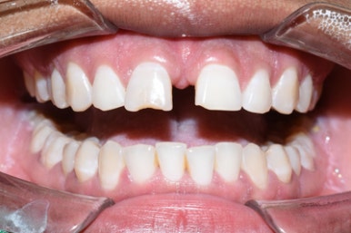 서울시청역치과/ 벌어진 앞니 치아 치료/ 왜소치, 다이아스테마 등/레진, 라미네이트, 부분교정 비교 관련 이미지 24