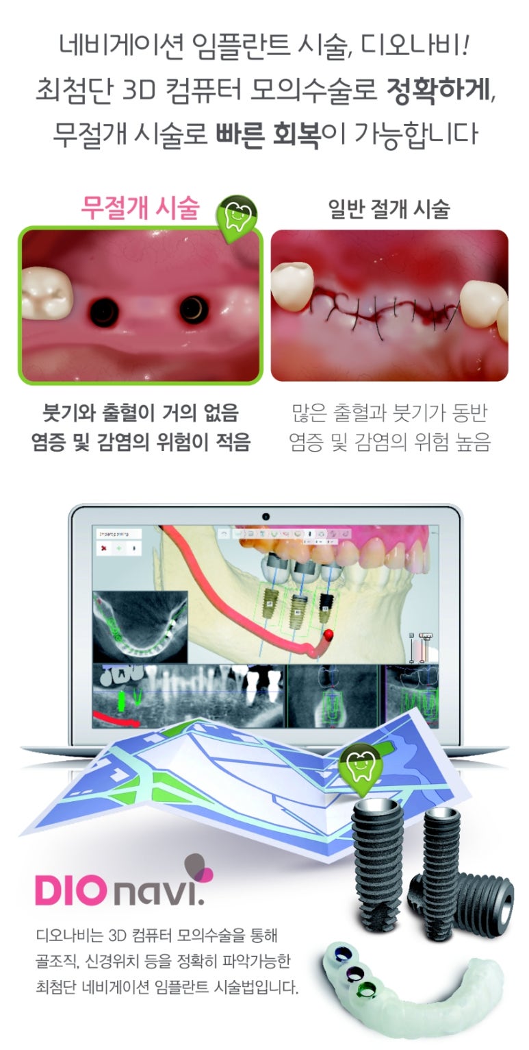 [광화문임플란트]임플란트 많이 아픈가요? 겁이 많아요 -네비게이션 임플란트 사례 관련 이미지 1