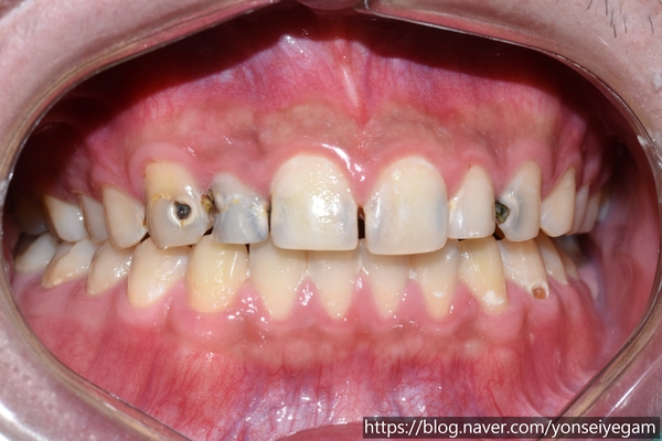 시청역치과 심한 (앞니)충치 치료방법 전후 사례 살펴보아요 관련 이미지 2