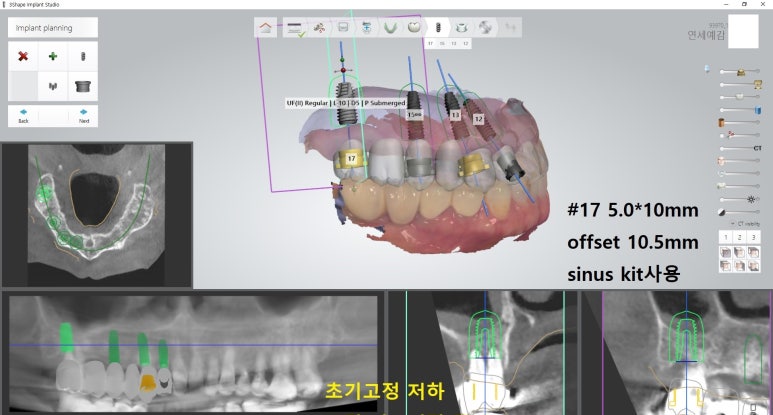 충정로 서울역 근처 고난도 & 재수술 임플란트 수술 치과 관련 이미지 14