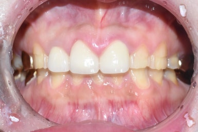 [시청역/광화문] 부식된 노란치아. 정말 하얀, 새하얀 치아로 만들고 싶어요 비용도 알려드려요 관련 이미지 4