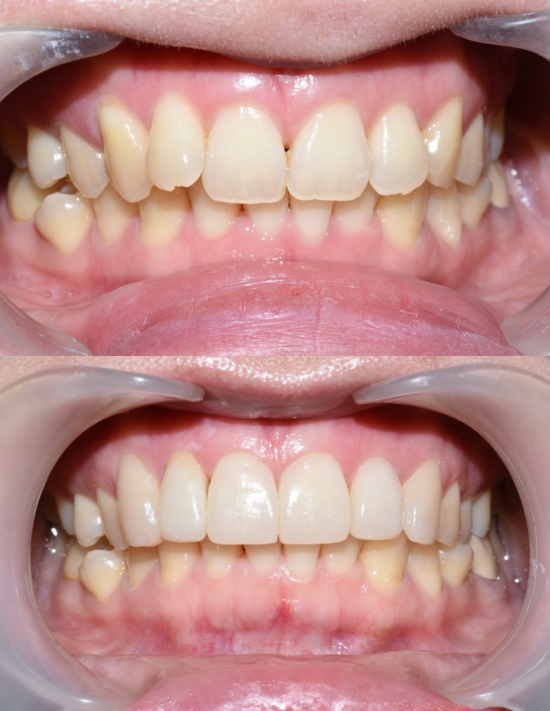 VENEER in Seoul, Korea/ Cost, Cases(before&after photos)/ YONSEI YEGAM DENTAL CLINIC 관련 이미지 10