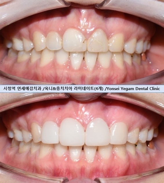 치아를 하얗게 하고 싶은 캐나다에서 오신 환자분의 라미네이트 사진공개이벤트진행중 관련 이미지 7