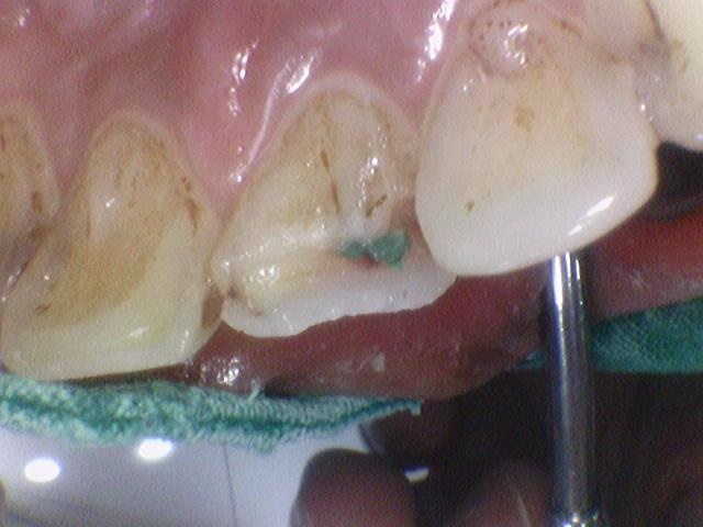 서울시청역 남대문 임플란트 대신에 앞니 브릿지를 한 케이스 관련 이미지 6