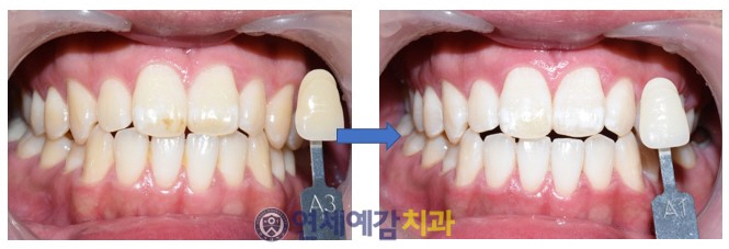 [광화문]해외에서도 찾아오는 원데이치아미백/이벤트가격/실제사례 관련 이미지 3