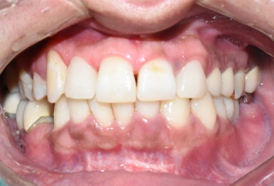 1.송곳니를 다른 앞니 모양 라미네이트로, 2.치아사이 빈공간을 라미네이트로 관련 이미지 5