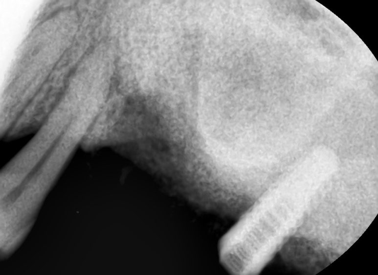 [서울시청역치과] 다른 치과에서 오래전에 한 임플란트가 흔들려요 &rarr;재수술 케이스 관련 이미지 7